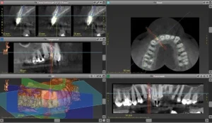 We planned the implant position virtually with our co diagnostix software and fabricated based on the planning a drill guide.