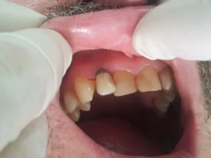 Right after the implantation of a Nobel Active implant with a diameter of 3.5mm and 13mm length, we placed a temporary abutment and a temporary crown.