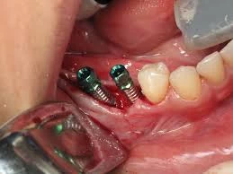 dental implant treatment