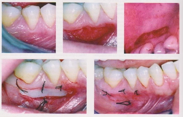 Free gingival graft