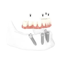 full-mouth-implants