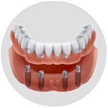 implants-supported-dentures