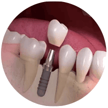single-implants_noback