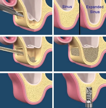 Sinus lift new
