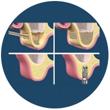 sinus-lift