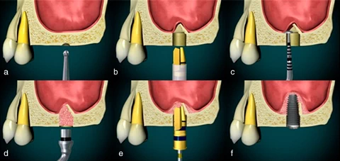 The transkrestal sinus lift