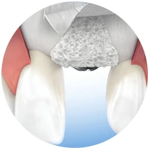 vertical-horizontal-bone-augmentation