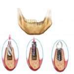 Dental Implant Procedure