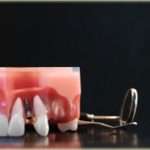 Implant Jaw