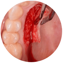 Soft Tissue Augmentation
