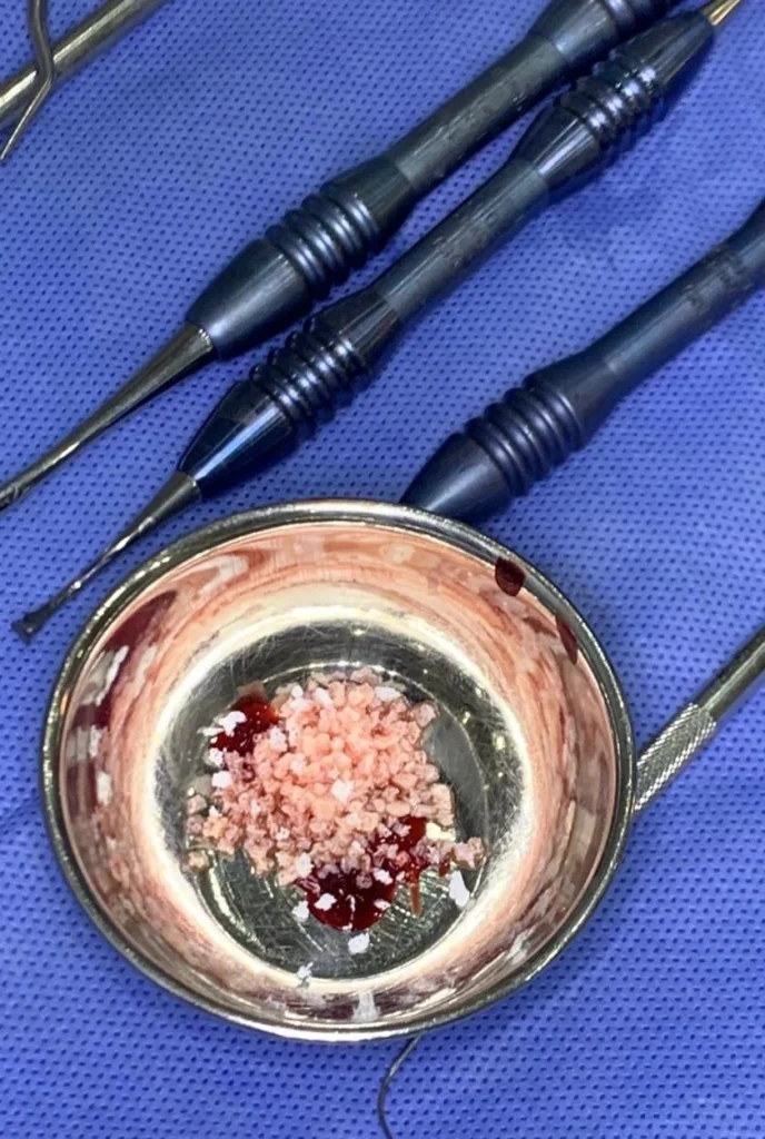 Bone-grafting.webp