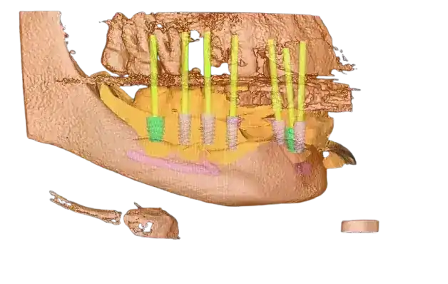 Dental Implant Drillguide