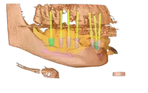 dental-implant-drillguide