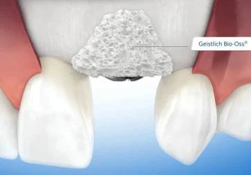 Bone Augmentation