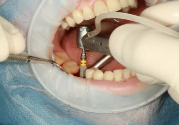 Dental-Implans Image